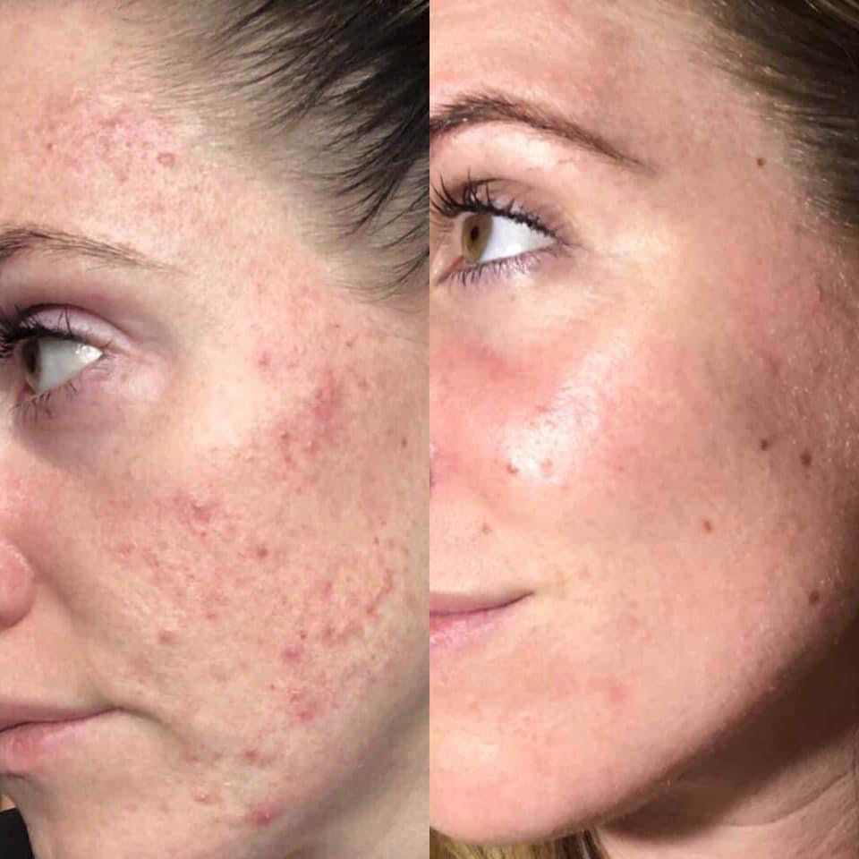 180° AHA Facial Peel and Neutralizer - Batavia Beauty