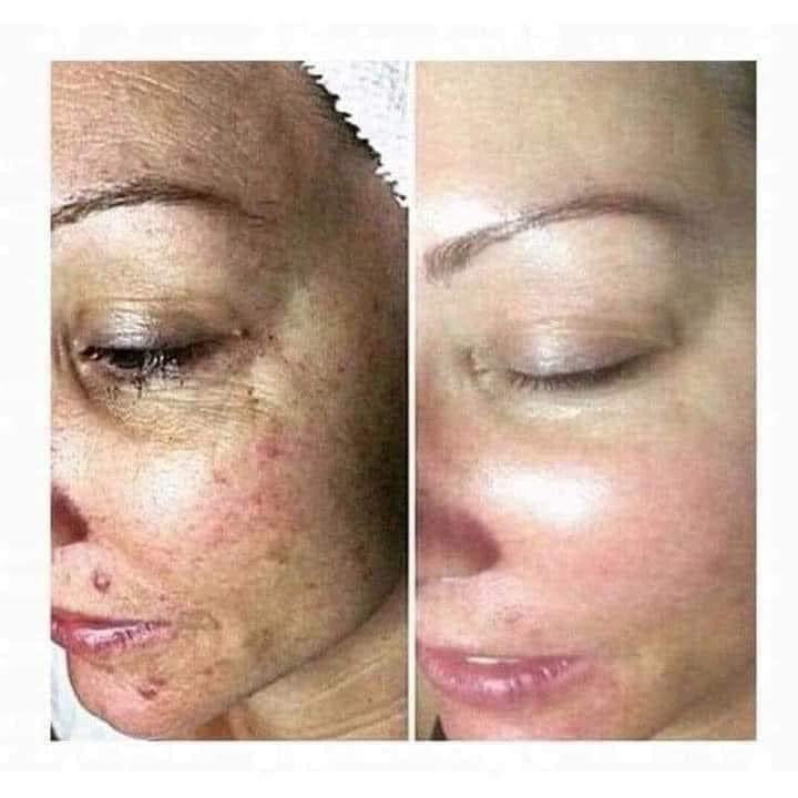 180° AHA Facial Peel and Neutralizer - Batavia Beauty