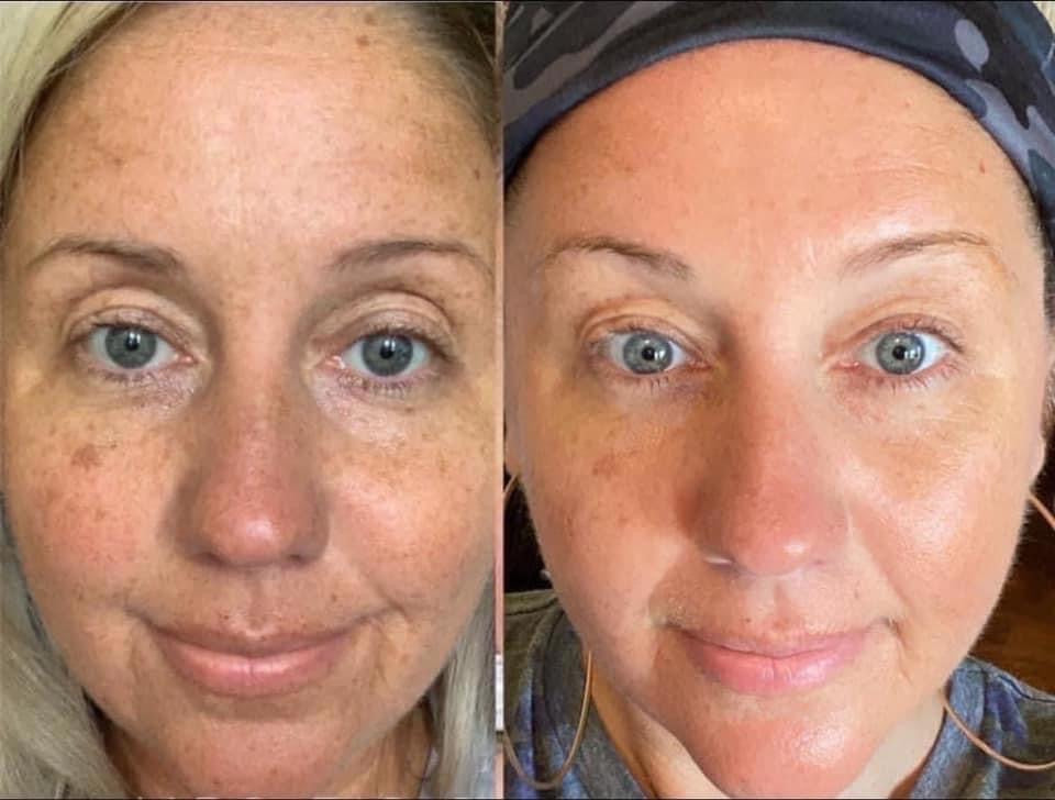 180° AHA Facial Peel and Neutralizer - Batavia Beauty