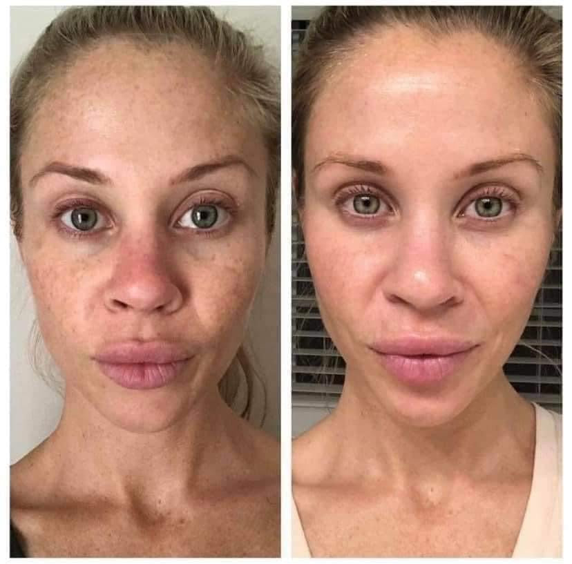 180° AHA Facial Peel and Neutralizer - Batavia Beauty