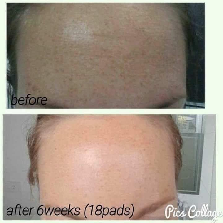 180° AHA Facial Peel and Neutralizer - Batavia Beauty