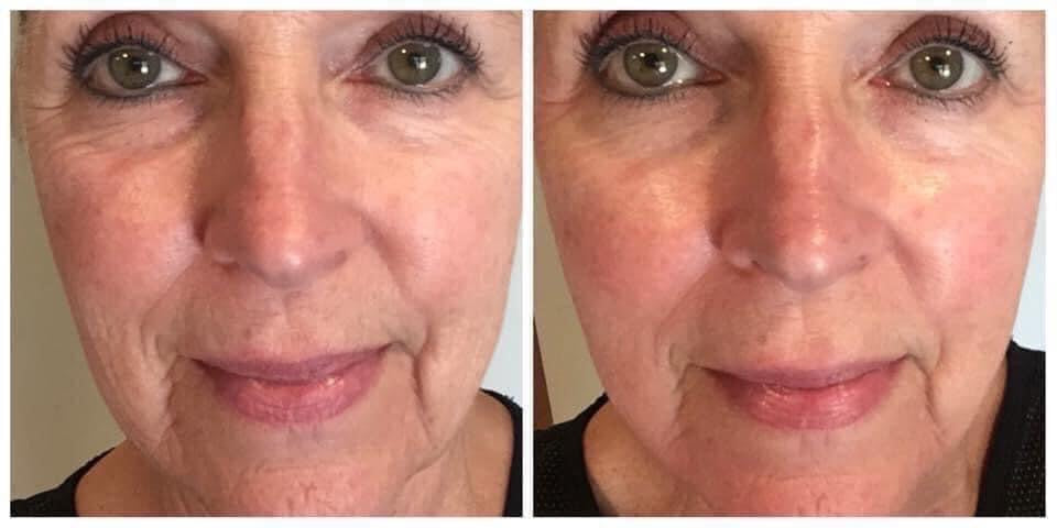 180° AHA Facial Peel and Neutralizer - Batavia Beauty