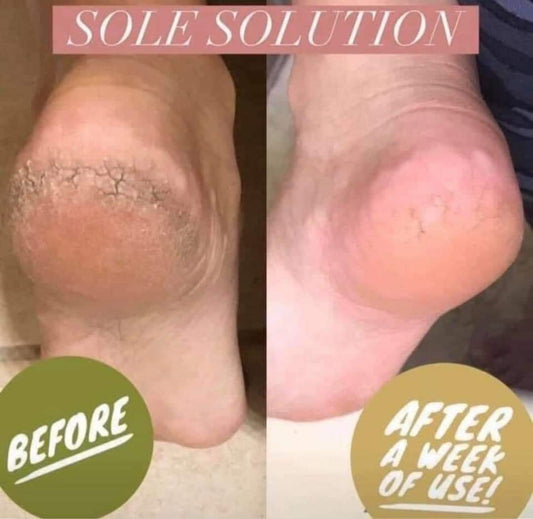 Epoch® Sole Solution® Foot Treatment - Batavia Beauty 